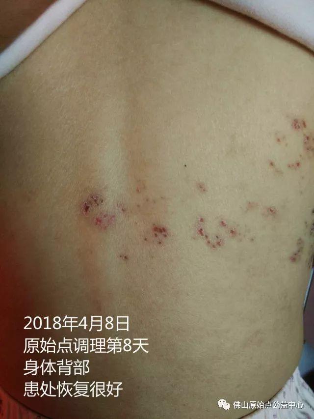 原始点调理带状疱疹：12天恢复+意外收获