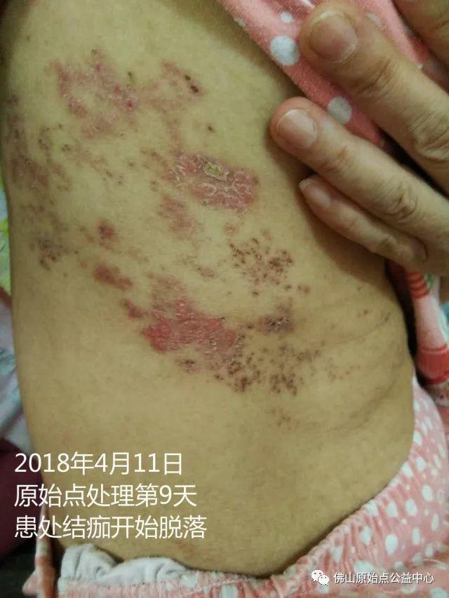 原始点调理带状疱疹：12天恢复+意外收获