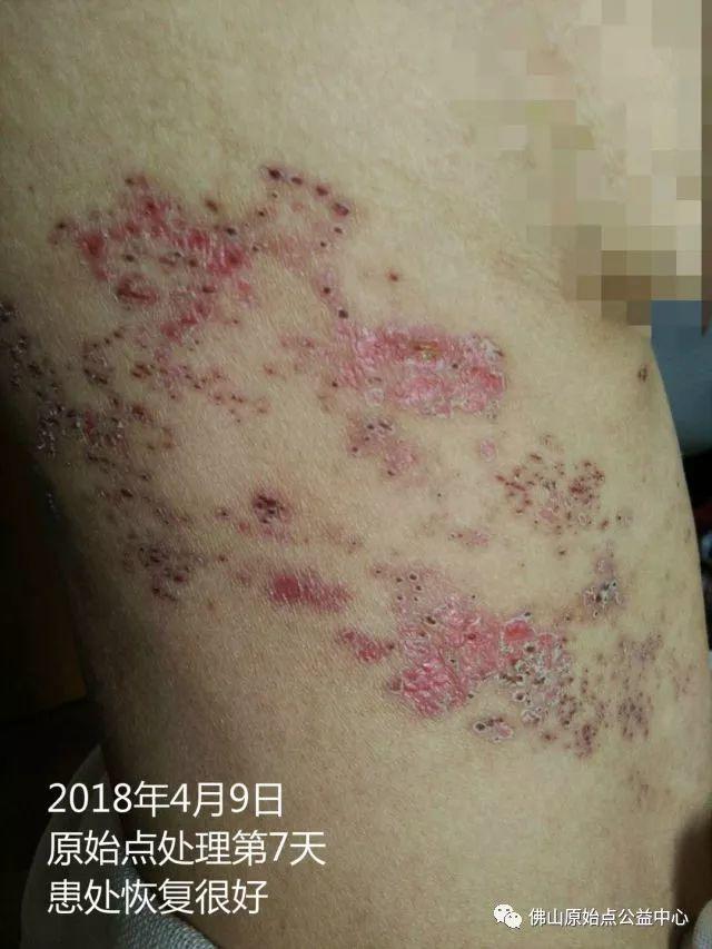 原始点调理带状疱疹：12天恢复+意外收获