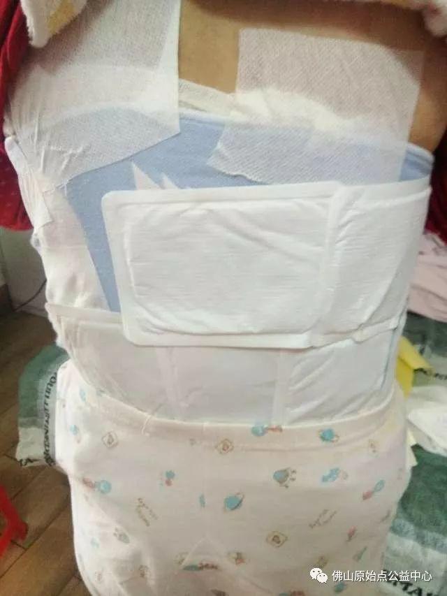 原始点调理带状疱疹：12天恢复+意外收获