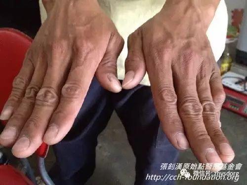 [經驗分享] 原始點應用分享-處理虎頭蜂螫傷