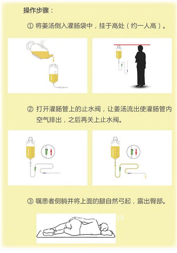 原始点姜汤灌肠工具介绍及步骤详解 原始点姜汤灌肠工具介绍及步骤详解