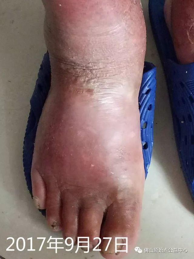 原始点调理全身肿胀溃烂:九个月,雨过天睛 原始点调理全身肿胀溃烂:九个月,雨过天睛