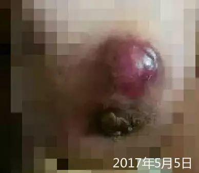 原始点调理乳腺癌伤口溃烂:好好做,效果看得见 原始点调理乳腺癌伤口溃烂:好好做,效果看得见