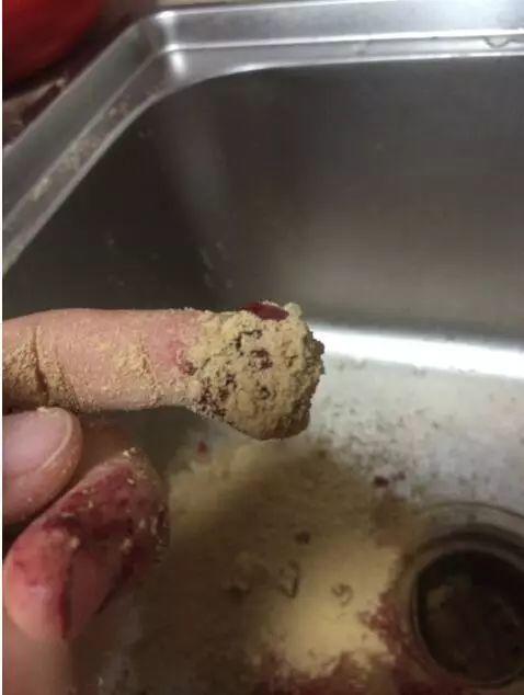 本中心学员花开伊宁:原始点处理夹断手指,效果杠杠的 本中心学员花开伊宁:原始点处理夹断手指,效果杠杠的