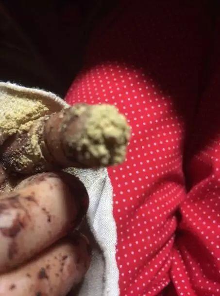 本中心学员花开伊宁:原始点处理夹断手指,效果杠杠的 本中心学员花开伊宁:原始点处理夹断手指,效果杠杠的