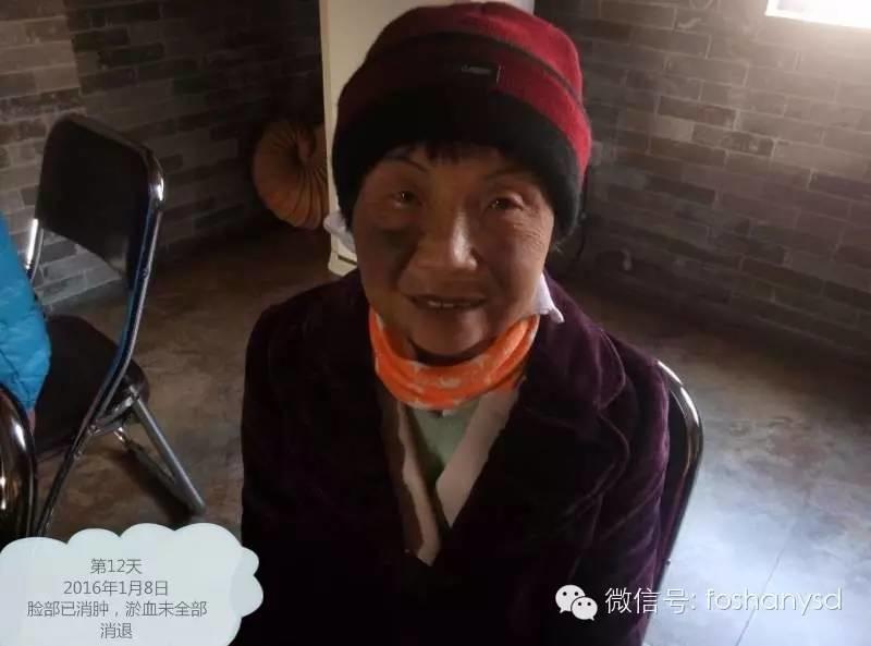 原始点处理摔伤淤肿杠杠的 原始点处理摔伤淤肿杠杠的