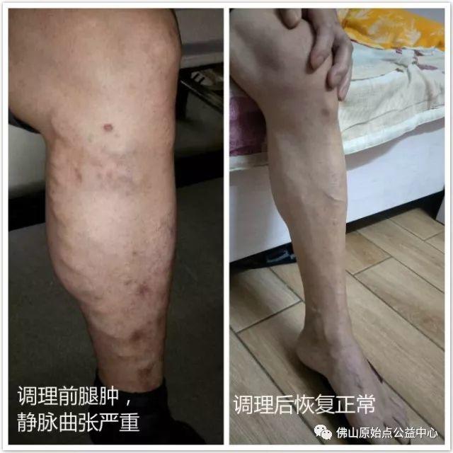 原始点调理全身麻木疼痛肿胀案例 原始点调理全身麻木疼痛肿胀案例