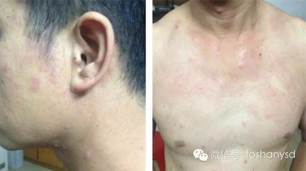 16年牛皮癣康复案例分享 16年牛皮癣康复案例分享