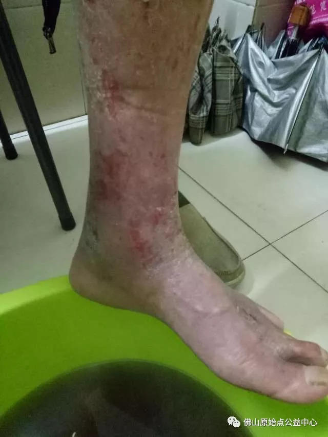 原始点调理全身肿胀溃烂:九个月,雨过天睛 原始点调理全身肿胀溃烂:九个月,雨过天睛