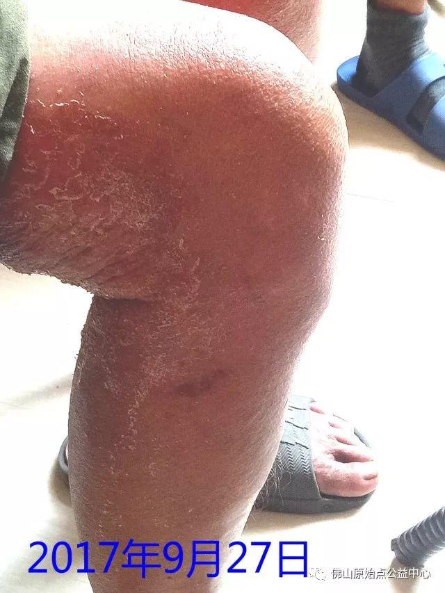 原始点调理全身肿胀溃烂:九个月,雨过天睛 原始点调理全身肿胀溃烂:九个月,雨过天睛