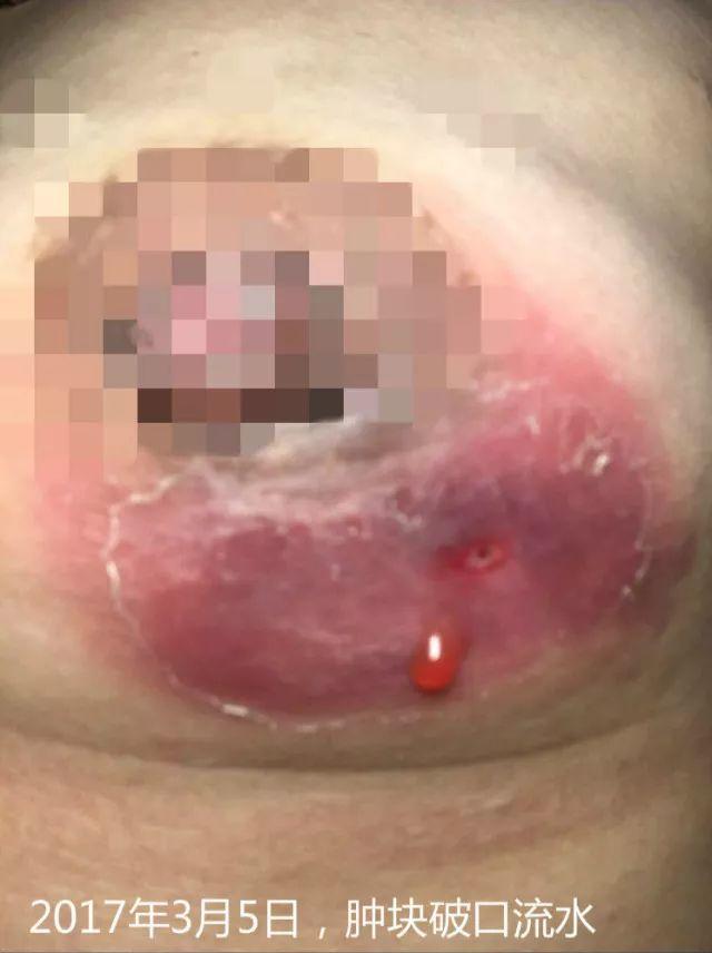 原始点调理乳房溃烂:一位德国媳妇飞越半球的原始点求医经历 原始点调理乳房溃烂:一位德国媳妇飞越半球的原始点求医经历