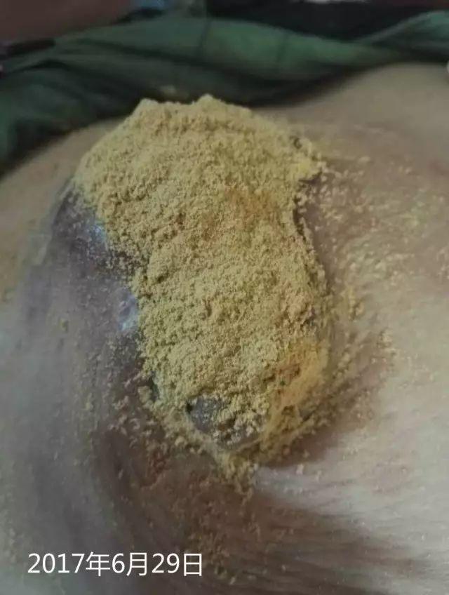 原始点调理乳腺癌伤口溃烂:好好做,效果看得见 原始点调理乳腺癌伤口溃烂:好好做,效果看得见