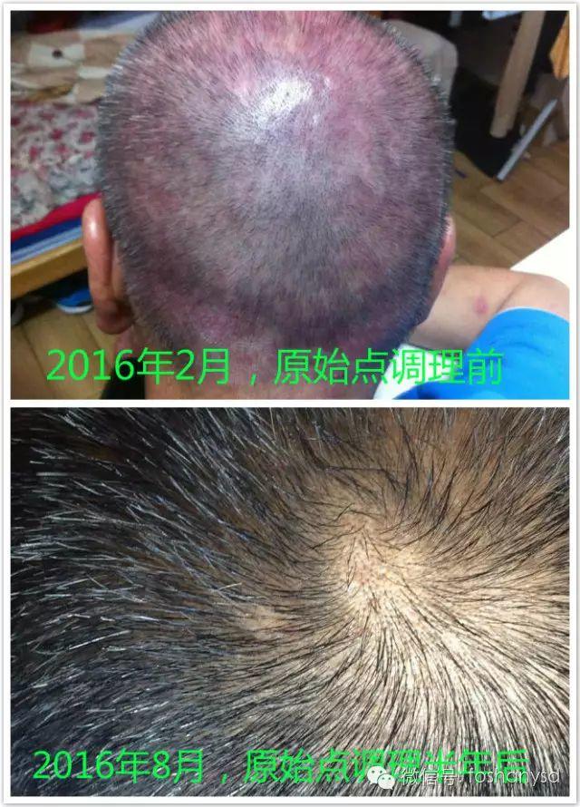 触目惊心 原始点调理八年病史牛皮癣,半年基本恢复健康 触目惊心 原始点调理八年病史牛皮癣,半年基本恢复健康