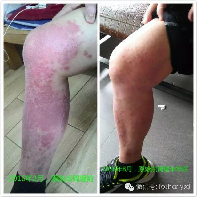 触目惊心 原始点调理八年病史牛皮癣,半年基本恢复健康 触目惊心 原始点调理八年病史牛皮癣,半年基本恢复健康