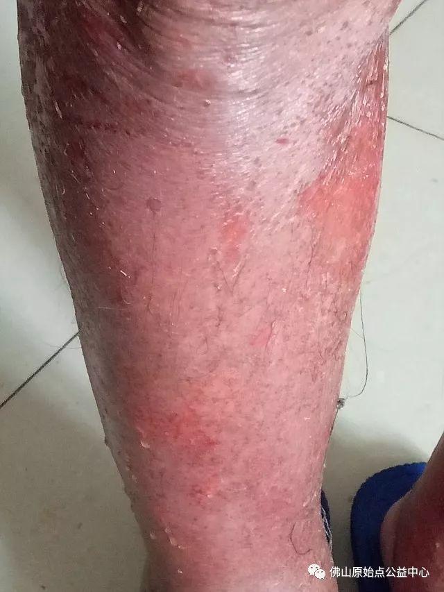 原始点调理全身肿胀溃烂:九个月,雨过天睛 原始点调理全身肿胀溃烂:九个月,雨过天睛