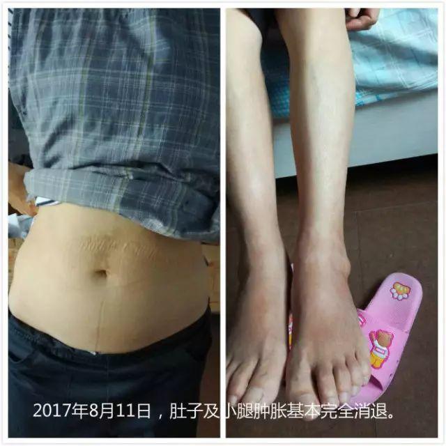 原始点调理腹水双下肢水肿:清晰的观念+信心 成就健康 原始点调理腹水双下肢水肿:清晰的观念+信心 成就健康