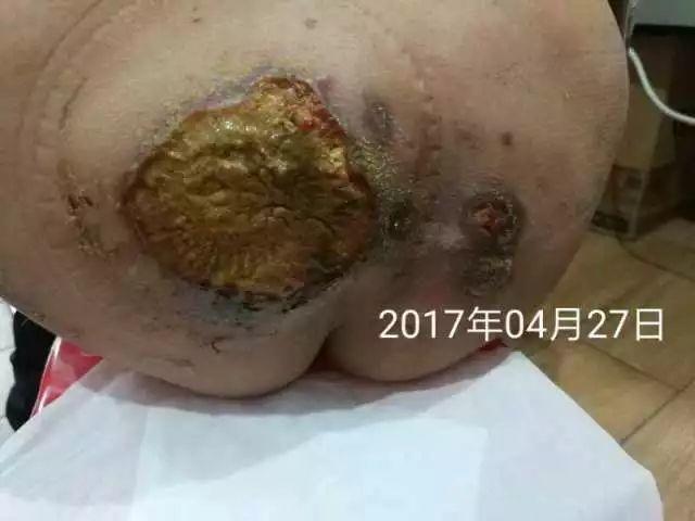 原始点调理淋巴瘤严重溃烂:无任何介入治疗愈合 原始点调理淋巴瘤严重溃烂:无任何介入治疗愈合