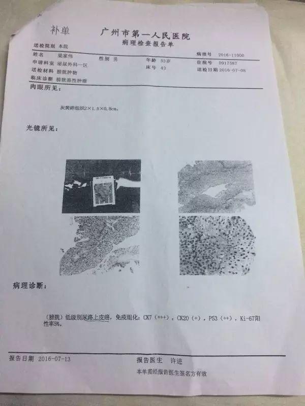 原始点调理膀胱癌:绝境逢生 原始点调理膀胱癌:绝境逢生