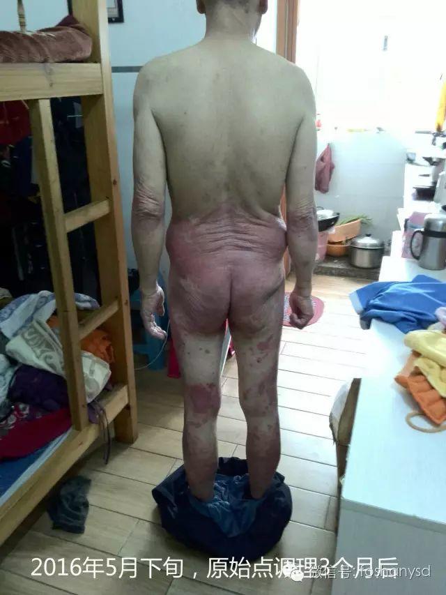 触目惊心 原始点调理八年病史牛皮癣,半年基本恢复健康 触目惊心 原始点调理八年病史牛皮癣,半年基本恢复健康