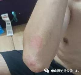 原始点调理九年史牛皮癣:二十天大变化 原始点调理九年史牛皮癣:二十天大变化