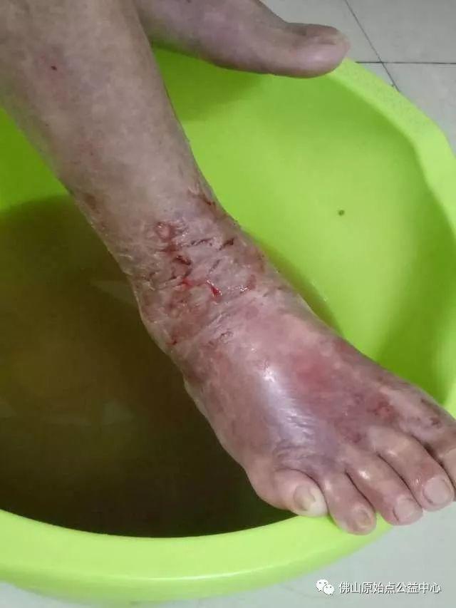 原始点调理全身肿胀溃烂:九个月,雨过天睛 原始点调理全身肿胀溃烂:九个月,雨过天睛