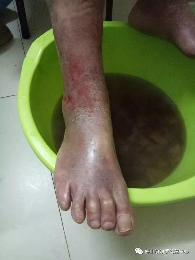 原始点调理全身肿胀溃烂:九个月,雨过天睛 原始点调理全身肿胀溃烂:九个月,雨过天睛