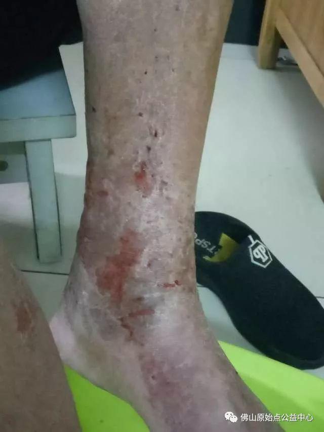 原始点调理全身肿胀溃烂:九个月,雨过天睛 原始点调理全身肿胀溃烂:九个月,雨过天睛