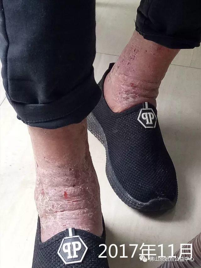 原始点调理全身肿胀溃烂:九个月,雨过天睛 原始点调理全身肿胀溃烂:九个月,雨过天睛