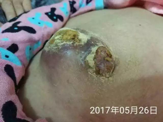 原始点调理乳腺癌伤口溃烂:好好做,效果看得见 原始点调理乳腺癌伤口溃烂:好好做,效果看得见