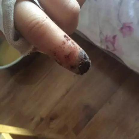 本中心学员花开伊宁:原始点处理夹断手指,效果杠杠的 本中心学员花开伊宁:原始点处理夹断手指,效果杠杠的