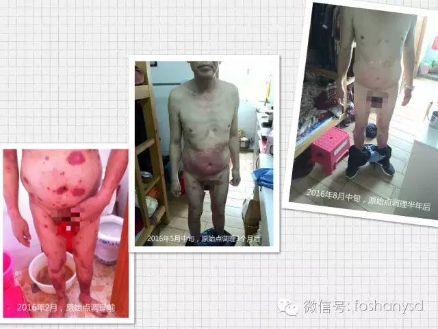 触目惊心 原始点调理八年病史牛皮癣,半年基本恢复健康 触目惊心 原始点调理八年病史牛皮癣,半年基本恢复健康