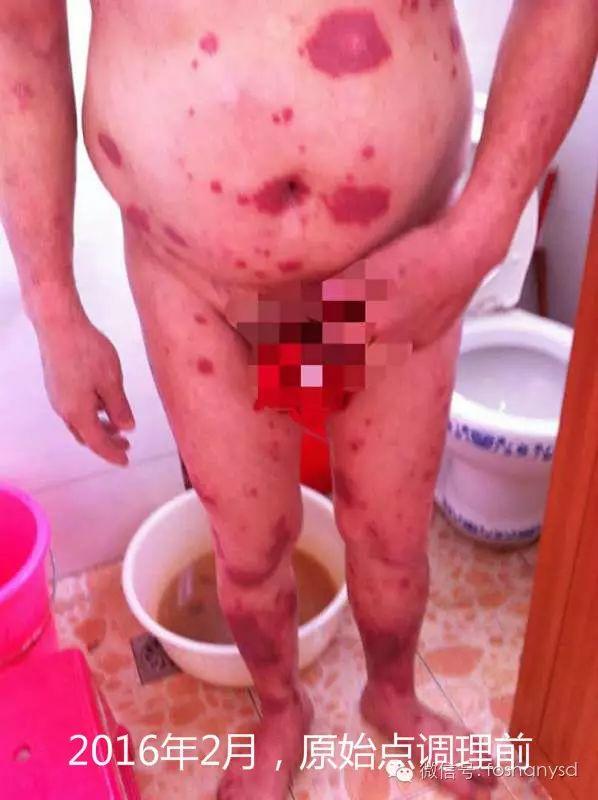 触目惊心 原始点调理八年病史牛皮癣,半年基本恢复健康 触目惊心 原始点调理八年病史牛皮癣,半年基本恢复健康