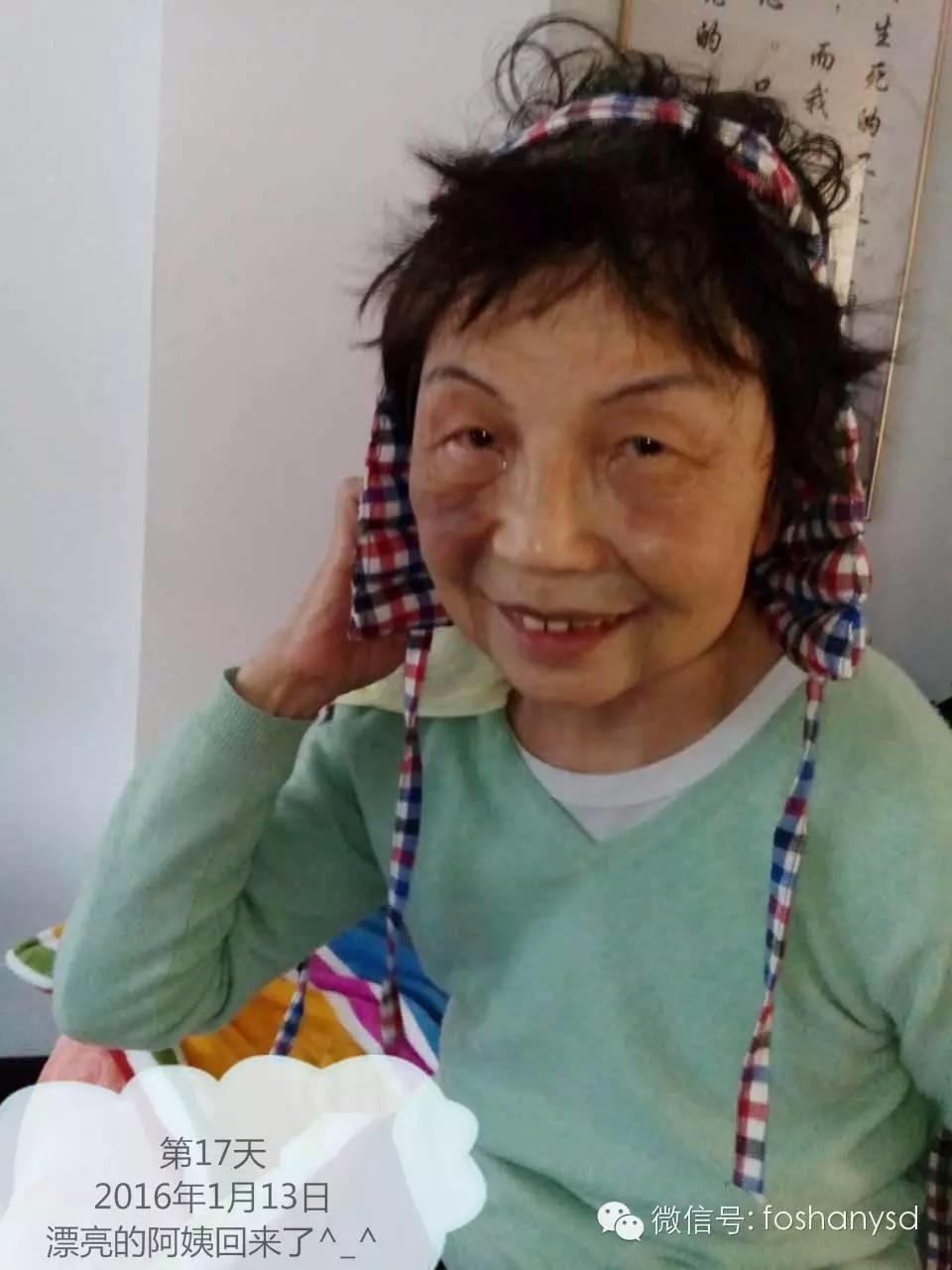 原始点处理摔伤淤肿杠杠的 原始点处理摔伤淤肿杠杠的