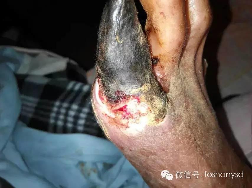 中国大陆“黑脚阿妈”感恩原始点让她免遭截肢之苦