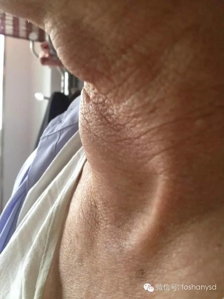 甲状腺结节、冠心病和高血压遇到原始点后症状基本化解 甲状腺结节、冠心病和高血压遇到原始点后症状基本化解