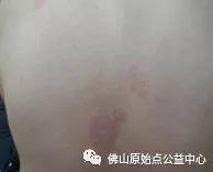 原始点调理九年史牛皮癣:二十天大变化 原始点调理九年史牛皮癣:二十天大变化