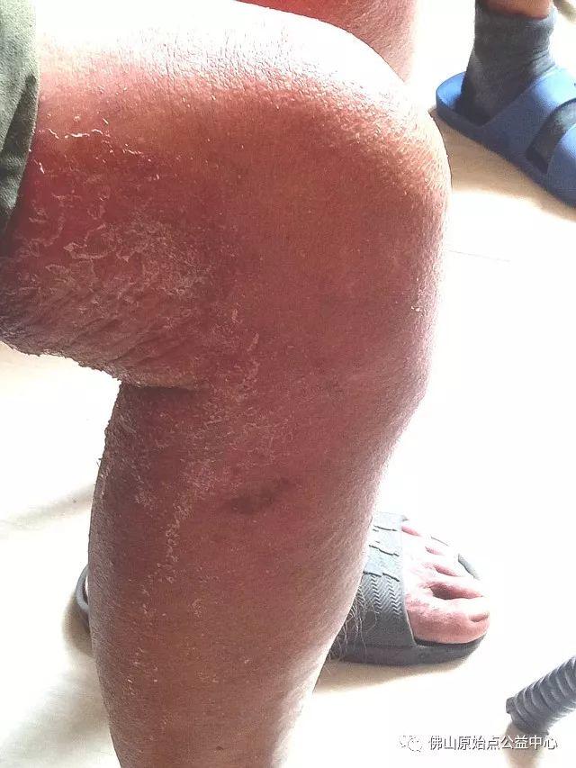 原始点调理全身肿胀溃烂:九个月,雨过天睛 原始点调理全身肿胀溃烂:九个月,雨过天睛