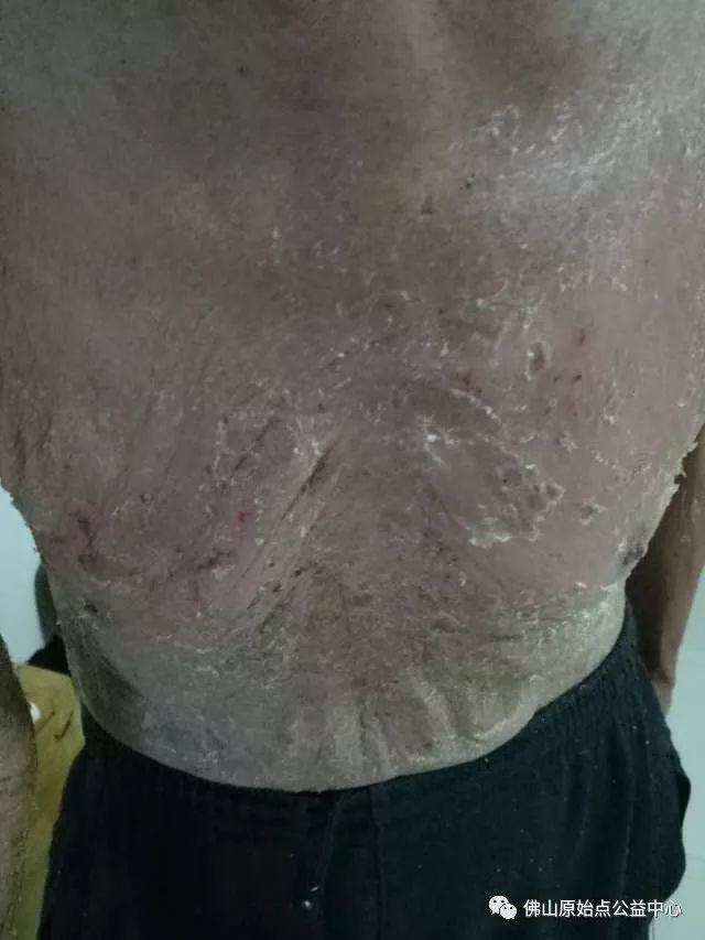 原始点调理全身肿胀溃烂:九个月,雨过天睛 原始点调理全身肿胀溃烂:九个月,雨过天睛