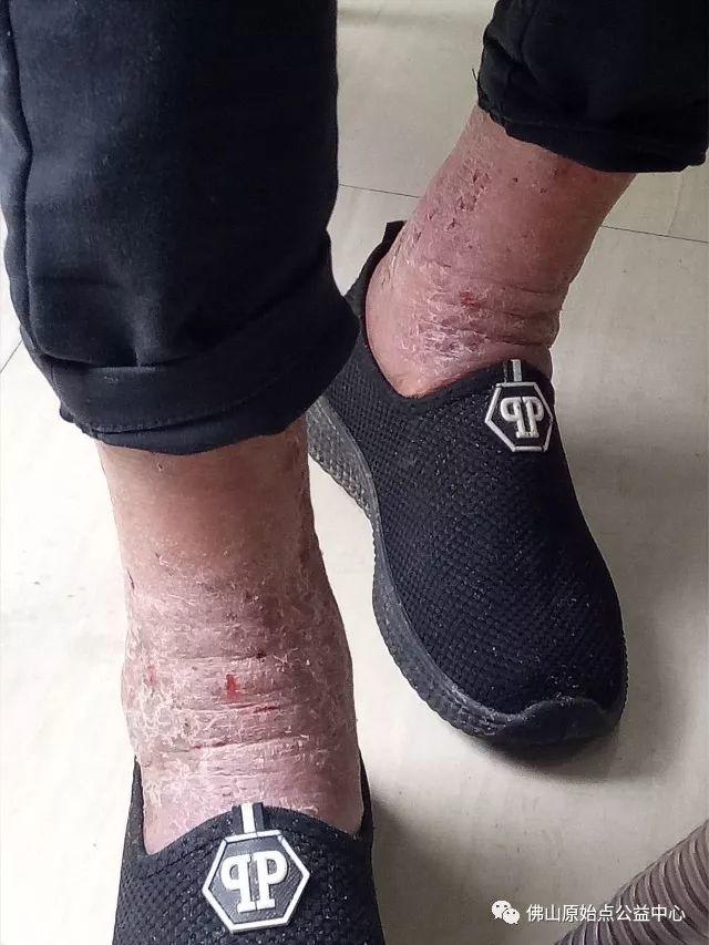 原始点调理全身肿胀溃烂:九个月,雨过天睛 原始点调理全身肿胀溃烂:九个月,雨过天睛