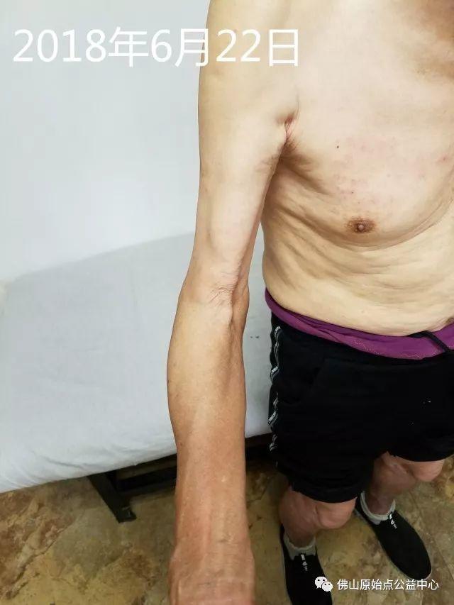 原始点调理全身肿胀溃烂:九个月,雨过天睛 原始点调理全身肿胀溃烂:九个月,雨过天睛