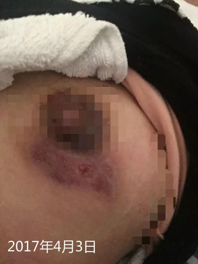 原始点调理乳房溃烂:一位德国媳妇飞越半球的原始点求医经历 原始点调理乳房溃烂:一位德国媳妇飞越半球的原始点求医经历