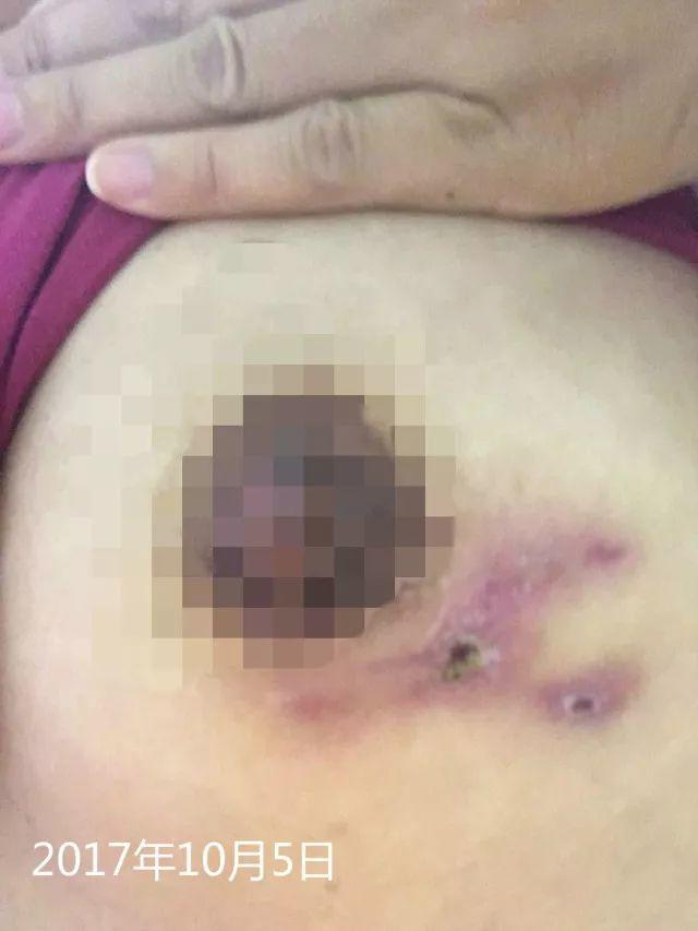 原始点调理乳房溃烂:一位德国媳妇飞越半球的原始点求医经历 原始点调理乳房溃烂:一位德国媳妇飞越半球的原始点求医经历