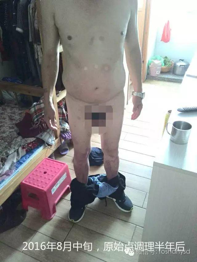 触目惊心 原始点调理八年病史牛皮癣,半年基本恢复健康 触目惊心 原始点调理八年病史牛皮癣,半年基本恢复健康