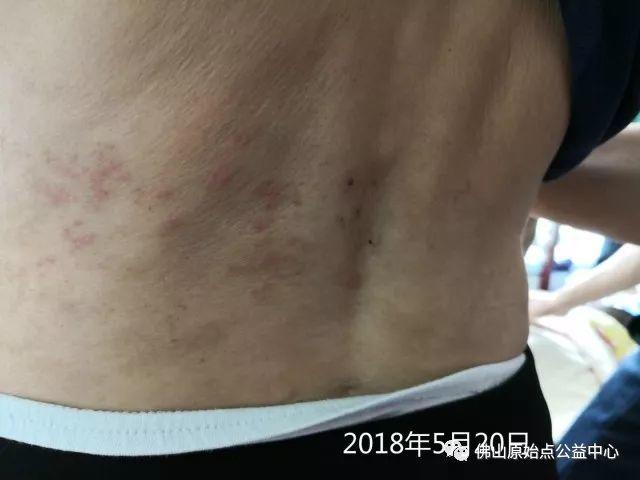 原始点调理带状疱疹：轻松快捷效果好