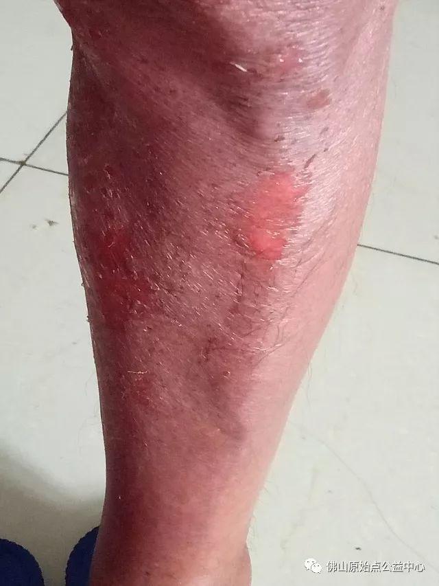 原始点调理全身肿胀溃烂:九个月,雨过天睛 原始点调理全身肿胀溃烂:九个月,雨过天睛