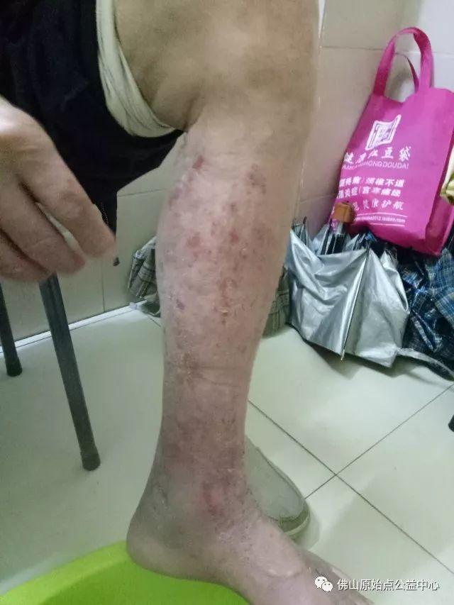 原始点调理全身肿胀溃烂:九个月,雨过天睛 原始点调理全身肿胀溃烂:九个月,雨过天睛