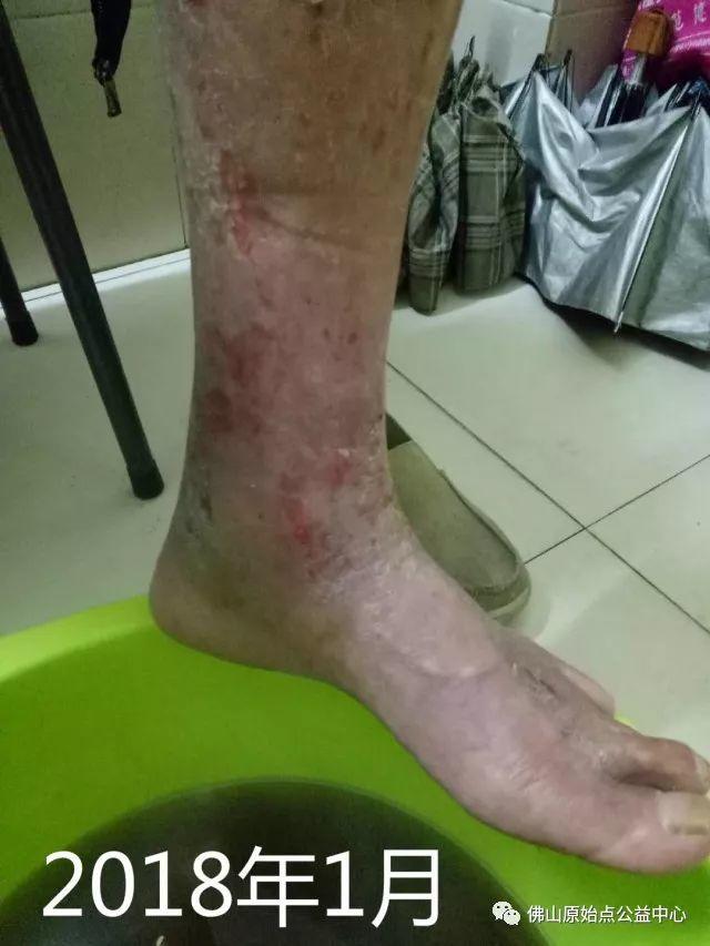 原始点调理全身肿胀溃烂:九个月,雨过天睛 原始点调理全身肿胀溃烂:九个月,雨过天睛