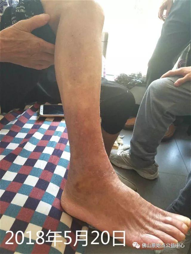 原始点调理全身肿胀溃烂:九个月,雨过天睛 原始点调理全身肿胀溃烂:九个月,雨过天睛