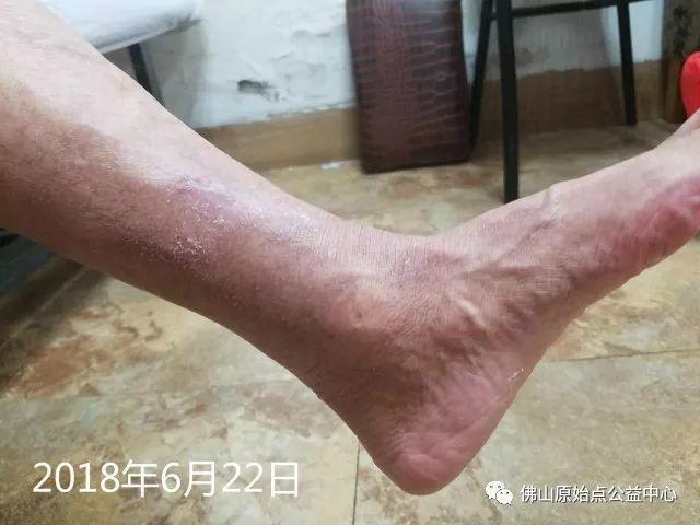 原始点调理全身肿胀溃烂:九个月,雨过天睛 原始点调理全身肿胀溃烂:九个月,雨过天睛